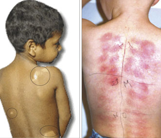 The most common skin diseases in Yemen involve allergies (R) and leprosy (L).