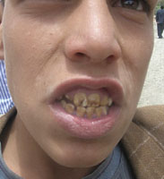 Many children in Sanhan ar have dental fluorosis.