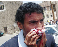 Nose bleed is his last concern. The road to press freedom requires much sacrifice.