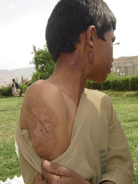 A street child in Sanaa suffering from a deformation due to burning accident.